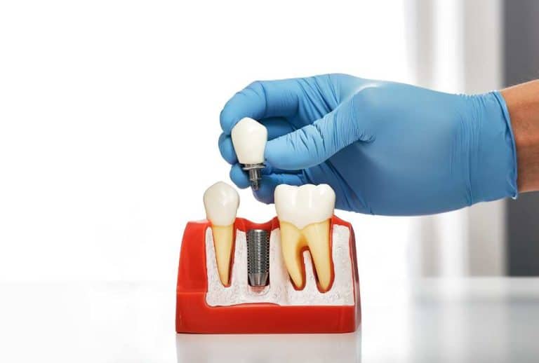 how to get financing for dental implants